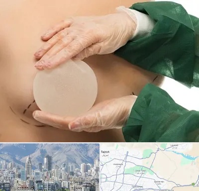 جراحی پروتز سینه در شمال شرق تهران