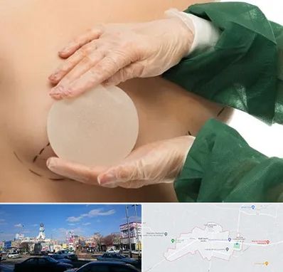 جراحی پروتز سینه در ماهدشت کرج