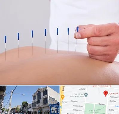 دکتر طب سوزنی در افسریه