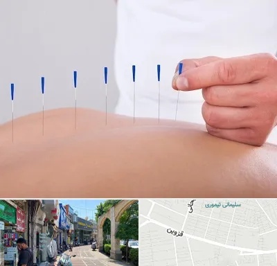 دکتر طب سوزنی در خیابان قزوین