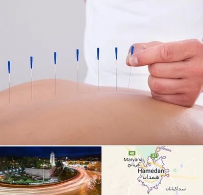 دکتر طب سوزنی در همدان