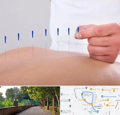 دکتر طب سوزنی در بلوار گیلان رشت