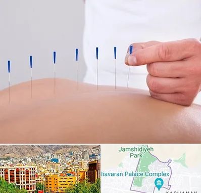 دکتر طب سوزنی در نیاوران 