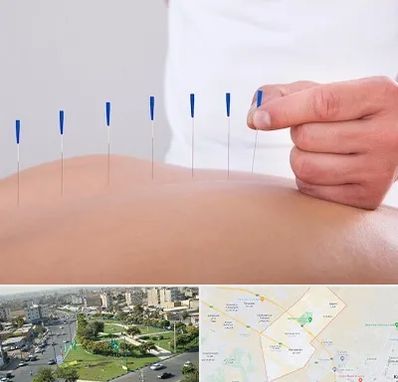 دکتر طب سوزنی در کمال شهر کرج