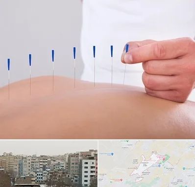 دکتر طب سوزنی در محمد شهر کرج