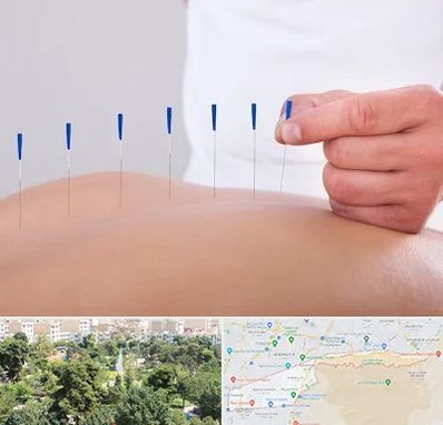 دکتر طب سوزنی در منطقه 13 تهران