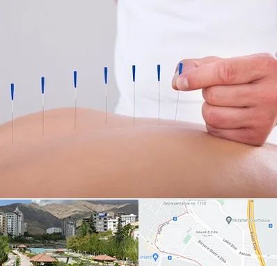 دکتر طب سوزنی در شهر زیبا