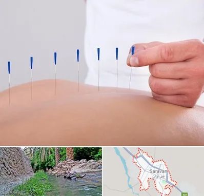 دکتر طب سوزنی در سراوان