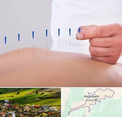 دکتر طب سوزنی در کلاردشت