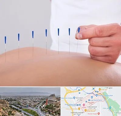 دکتر طب سوزنی در معالی آباد شیراز