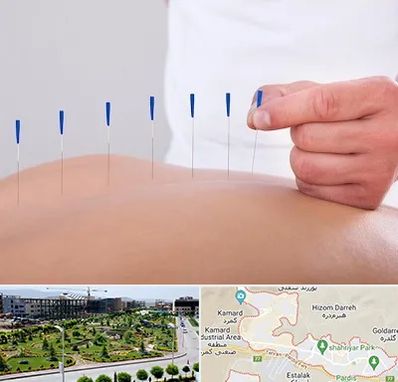 دکتر طب سوزنی در پردیس