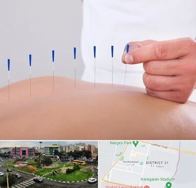 دکتر طب سوزنی در تهرانسر 