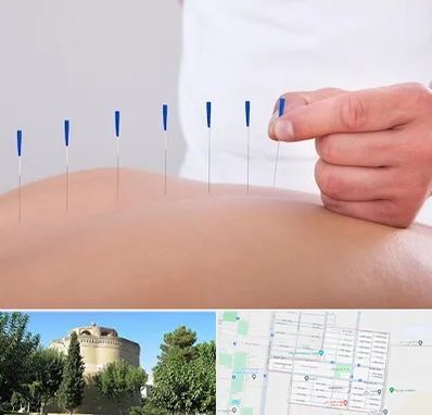 دکتر طب سوزنی در مرداویج اصفهان