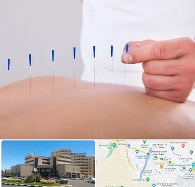 دکتر طب سوزنی در صیاد شیرازی مشهد