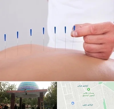 دکتر طب سوزنی در کیانشهر