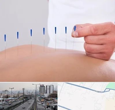 دکتر طب سوزنی در بلوار ارتش