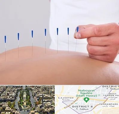 دکتر طب سوزنی در نارمک 