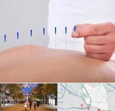 دکتر طب سوزنی در ولیعصر ارومیه