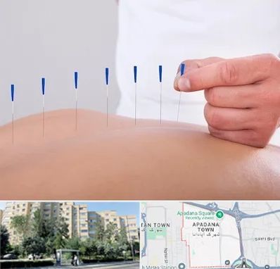 دکتر طب سوزنی در آپادانا