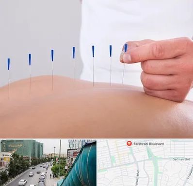 دکتر طب سوزنی در بلوار فرحزادی
