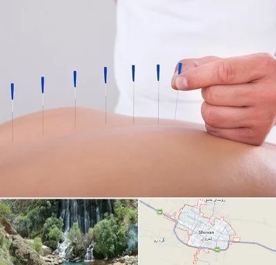 دکتر طب سوزنی در شیروان