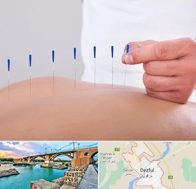 دکتر طب سوزنی در دزفول