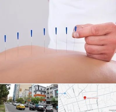 دکتر طب سوزنی در هفده شهریور تبریز