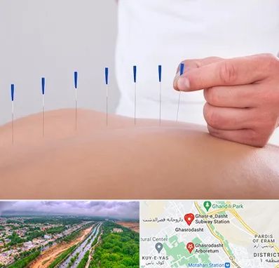 دکتر طب سوزنی در قصرالدشت شیراز