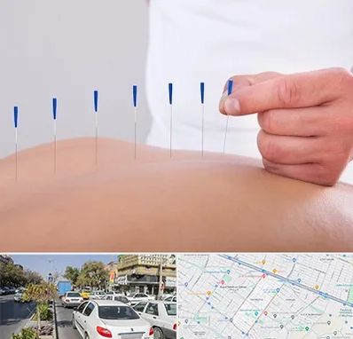 دکتر طب سوزنی در مفتح مشهد