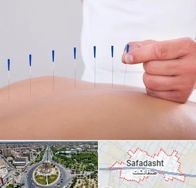 دکتر طب سوزنی در صفادشت