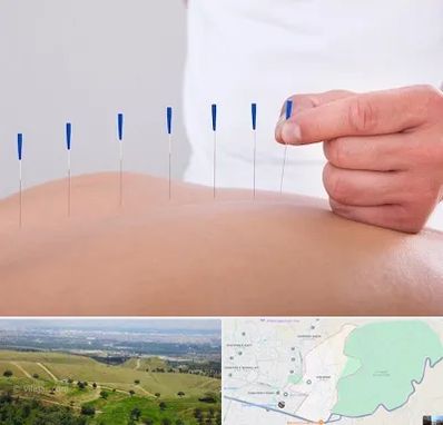 دکتر طب سوزنی در سوهانک