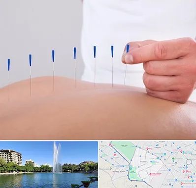 دکتر طب سوزنی در کوهسنگی مشهد