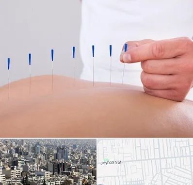 دکتر طب سوزنی در جیحون