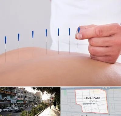 دکتر طب سوزنی در خیابان جمالزاده