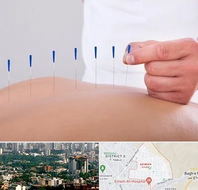 دکتر طب سوزنی در عظیمیه کرج 