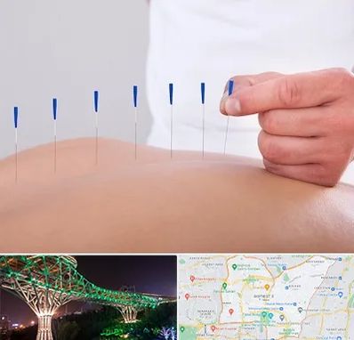 دکتر طب سوزنی در منطقه 3 تهران