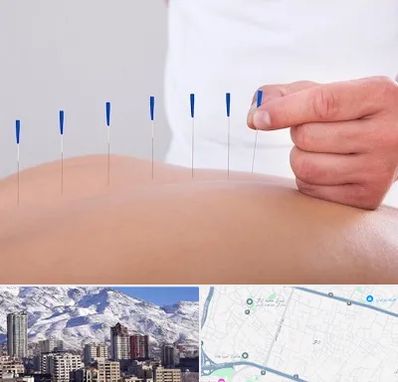 دکتر طب سوزنی در ازگل