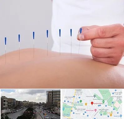 دکتر طب سوزنی در بلوار فردوسی مشهد