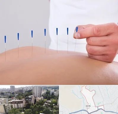 دکتر طب سوزنی در اوین