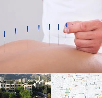 دکتر طب سوزنی در دیباجی