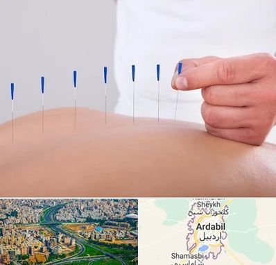 دکتر طب سوزنی در اردبیل