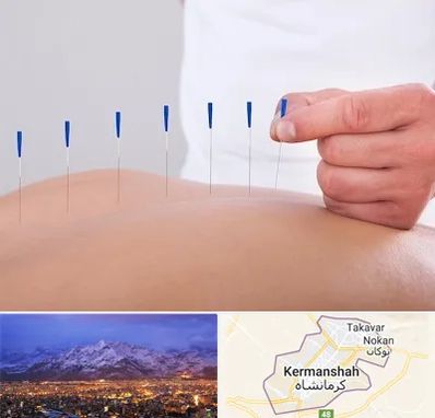 دکتر طب سوزنی در کرمانشاه