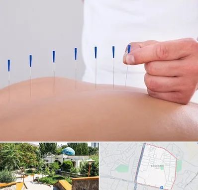 دکتر طب سوزنی در باغمیشه تبریز