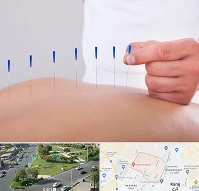 دکتر طب سوزنی در شاهین ویلا کرج