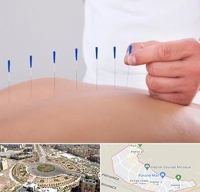 دکتر طب سوزنی در پرند