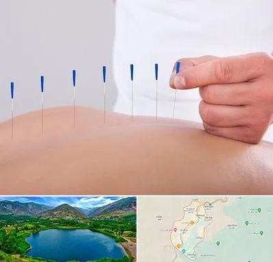 دکتر طب سوزنی در رودبار