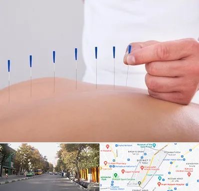 دکتر طب سوزنی در شریعتی