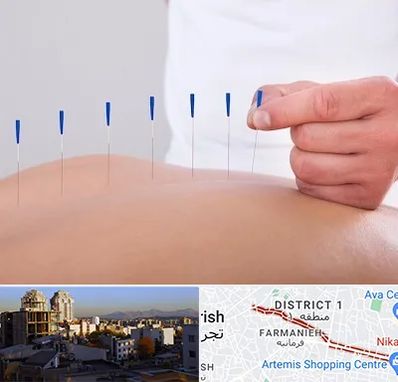 دکتر طب سوزنی در فرمانیه 