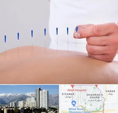 دکتر طب سوزنی در شهرک غرب 