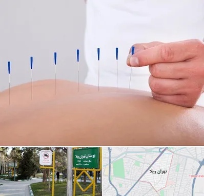 دکتر طب سوزنی در تهران ویلا